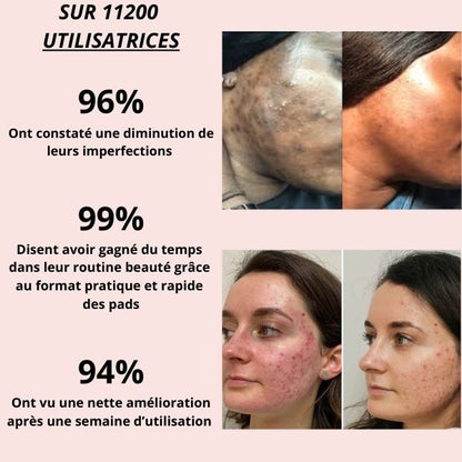 Pads Anti-Imperfections au Curcuma et Acide Kojique - soin complet 6en1